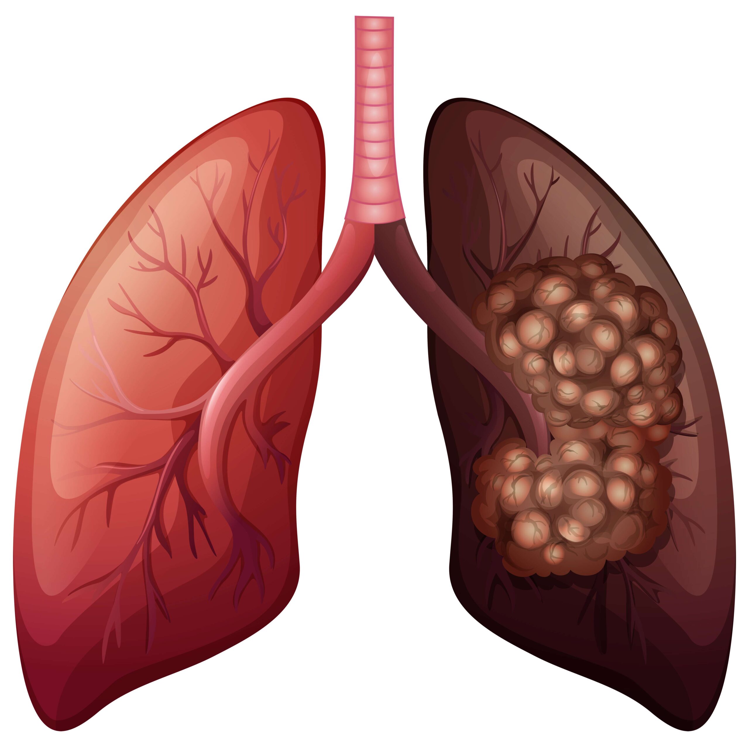 lung cancer.jpg